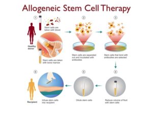 Stem cell therapy explained