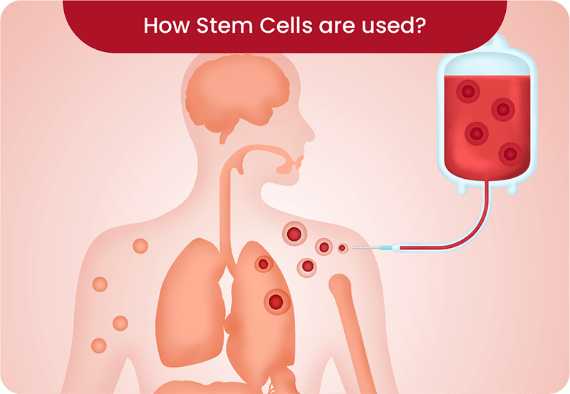 Cord Blood Treatments